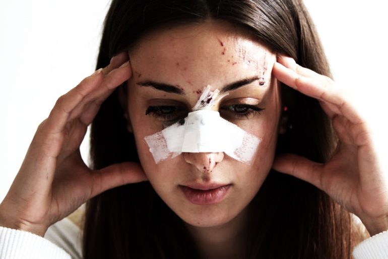 How to Understanding Facial Scar Claims After Car Accidents